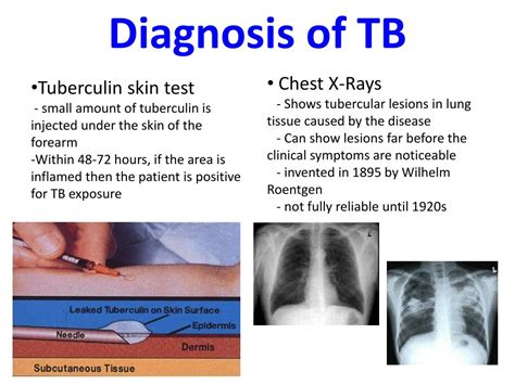 PPT - Tuberculosis PowerPoint Presentation, free download - ID:2176707