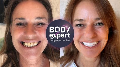 Dental implants: before - after, results after placement | Body Expert