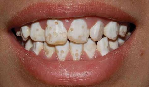 Hypoplasia (of enamel) - Definition of Hypoplasia (of enamel)