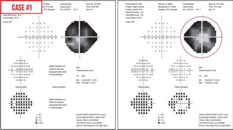 Neurological Visual Field Defect