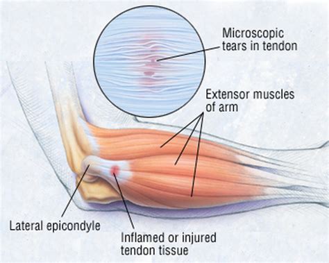 Elbow tendon injury - David Kummerfeld MD