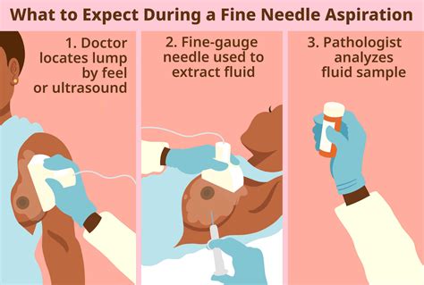 Feasibility Thermal call core needle aspiration complement Supervise catch a cold