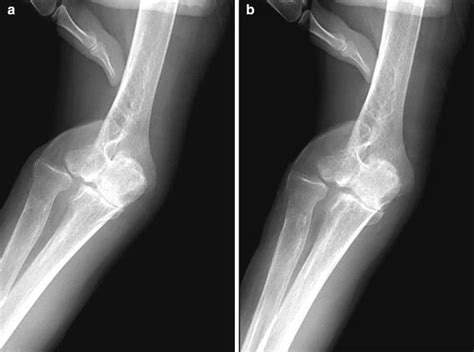 Stress examination under fluoroscopy. a Valgus and b varus stress. The... | Download Scientific ...