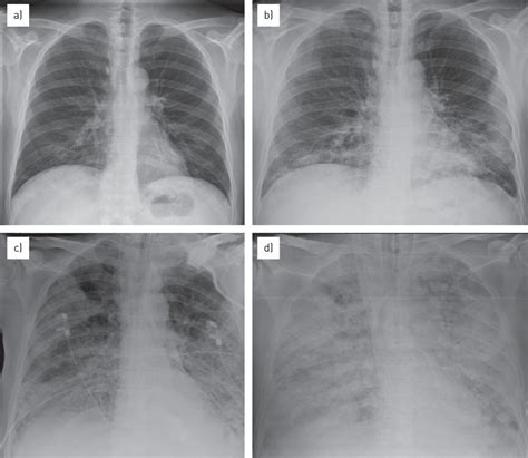 Overview of current lung imaging in acute respiratory distress syndrome ...