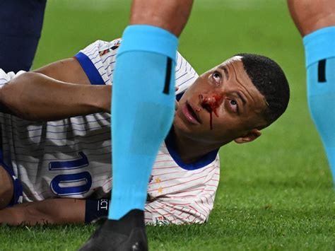 Mbappe Injury Euro 2024 - Kylie Minetta