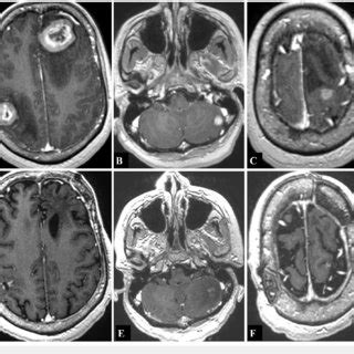 T1-weighted magnetic resonance imaging (MRI) with contrast showing... | Download Scientific Diagram