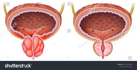 539 Prostate hyperplasia prostate cancer Images, Stock Photos & Vectors ...