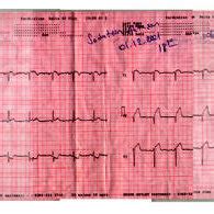 (PDF) Myocardial bridging as a cause of acute myocardial infarction: a case report