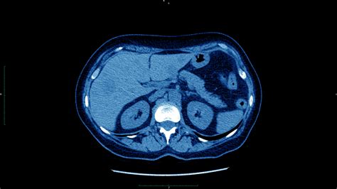 Focal Nodular Hyperplasia Liver Lesions