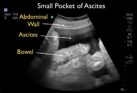 Ultrasound: Small pocket of ascites. | Download Scientific Diagram