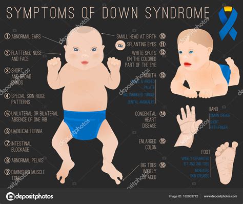 Down Syndrome Symptoms Diagram