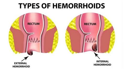 Home Treatments for Hemorrhoids – Entirely Health