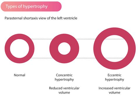 Hypertrophic Cardiomyopathy (HCM) & Hypertrophic Obstructive ...