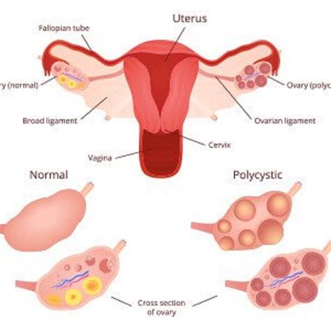 Stein Leventhal Syndrome(PCOS) | Kaggle