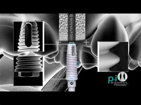 Osseointegration - YouTube