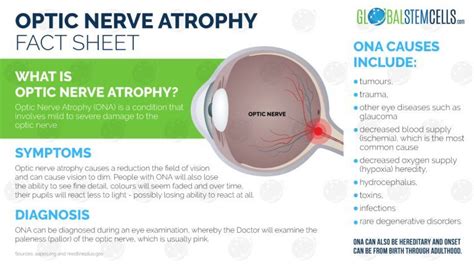 Patient's Improvements after Treatment for Optic Nerve Atrophy | GSC