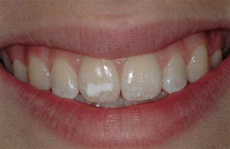 Enamel Hypoplasia in Children: Causes, Symptoms and Treatment Methods - VDM Dental Blog NY, 10014