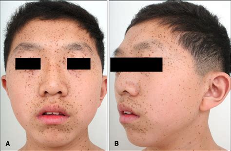 Figure 1 from LEOPARD Syndrome with PTPN11 Gene Mutation Showing Six Cardinal Symptoms of ...