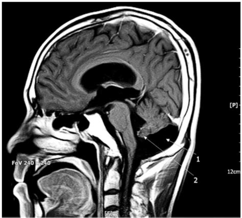 Dandy Walker Malformation Mri