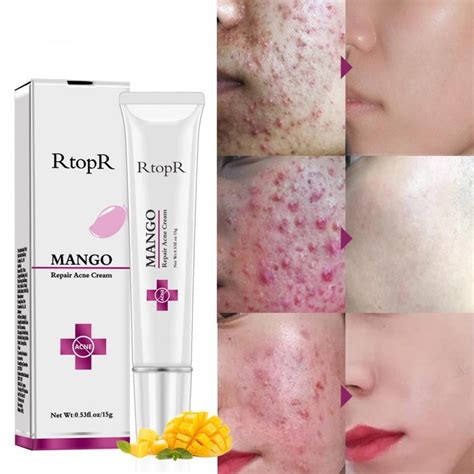 Repair Acne Cream,Acne Removal Cream, Pimple Treatment Cream Hydrating ...