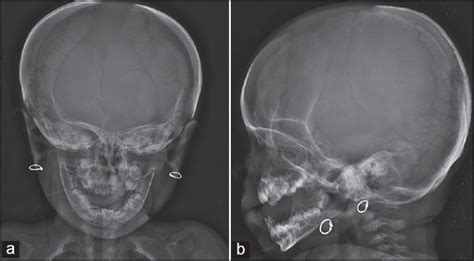 CLEIDOCRANIAL DYSPLASIA 2 | Buyxraysonline