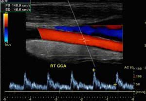 Carotid Artery Duplex Scan | K & T Diagnostic, Inc.