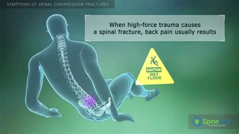 Spinal Compression Fractures Symptoms - YouTube