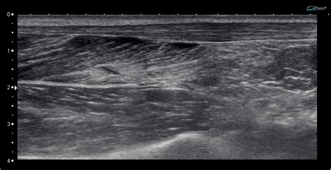 Ultrasound Images of Achilles Tendinopathy - Ankle, Foot and Orthotic Centre