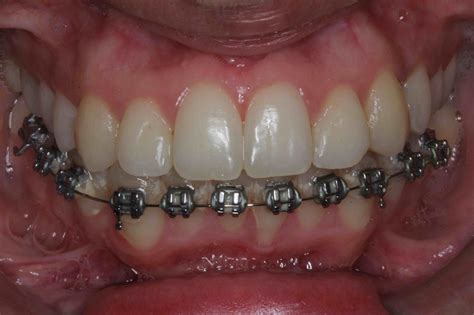 Porcelain Veneers or Braces? Make the Right Choice