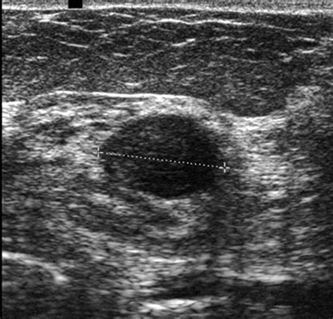 Breast Cyst Ultrasound