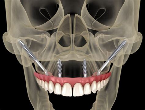 Zygomatic Dental Implants Fort Worth, Arlington, & Weatherford TX