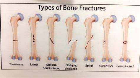 Types of Bone Fractures guide : coolguides | Bone fracture, Types of bones, Types of fractures