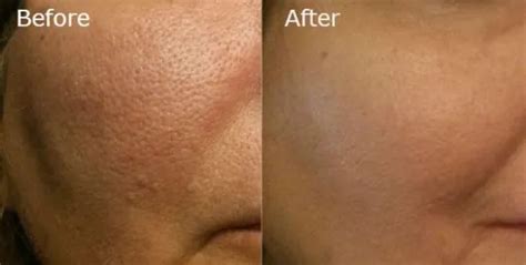 Microdermabrasion Before and After (Results + Pictures) - the daily glimmer