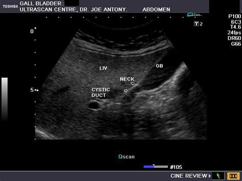 Gallbladder Ultrasound Transverse