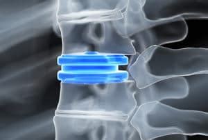 Disc Replacement | Interventional Spine & Surgery Group