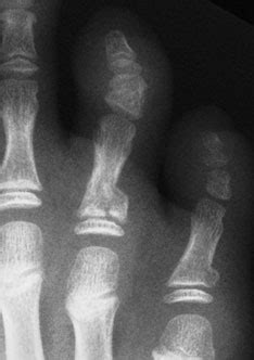 Broken Toe X Ray