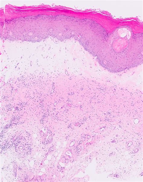 Lichen Sclerosis Histology