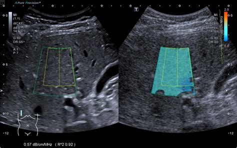 Ultrasound-Based Attenuation Imaging for the Non-Invasive ...