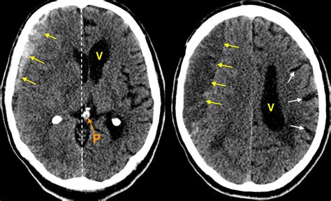 Acute on chronic subdural haematoma - Radiology at St. Vincent's University Hospital