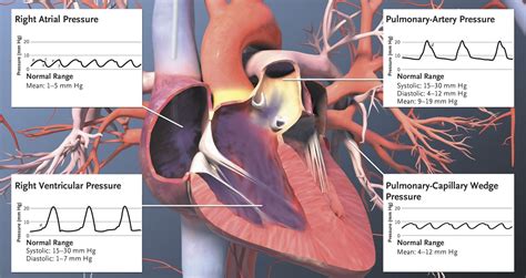 Right Heart Cath Pressure Waveforms