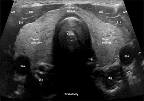 The sonographic characteristics exhibited by a normal thyroid US... | Download Scientific Diagram