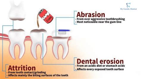 Tooth Wear: Causes, Prevention, and Treatment