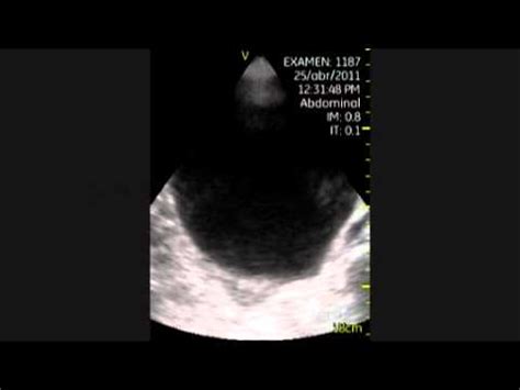 Distended Bladder • Video • MEDtube.net