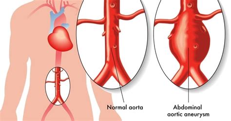 Abdominal Aortic Aneurysm (AAA) - familydoctor.org