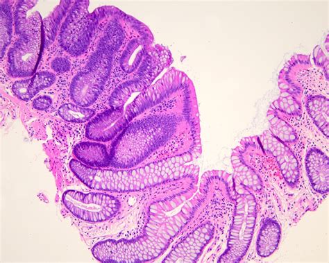 Pathology Outlines - Tubular adenoma