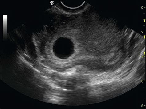 Amniotic Sac Ultrasound