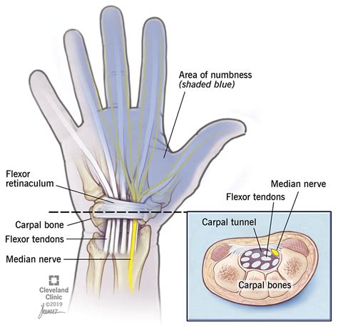 Carpal Tunnel Syndrome: Risk Factors, Symptoms & Treatment