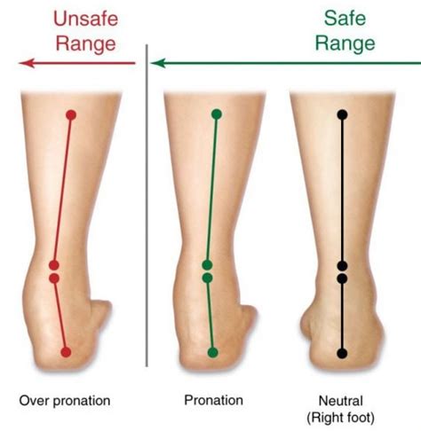 Overpronation: What Is It and How Can You Correct It?