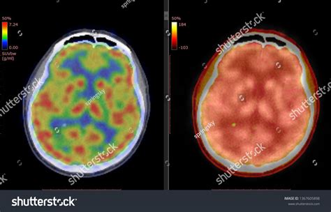 Pet Ct Scan Human Brain Axial Stock Photo 1367605898 | Shutterstock