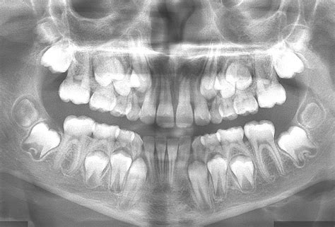 mixed-dentition-radiograph – Ace Achievers